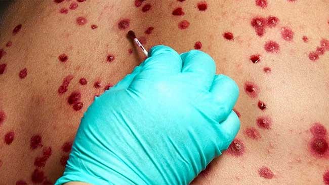 Un sanitario toma muestras de las p&uacute;stulas que presenta un paciente probable caso de viruela del mono