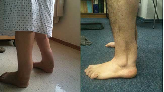 Personas afectadas de xantomatosis cerebrotendinosa